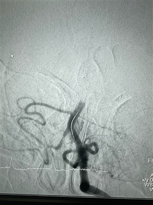 حالة جديدة لاسترجاع الدعامات الحفارة